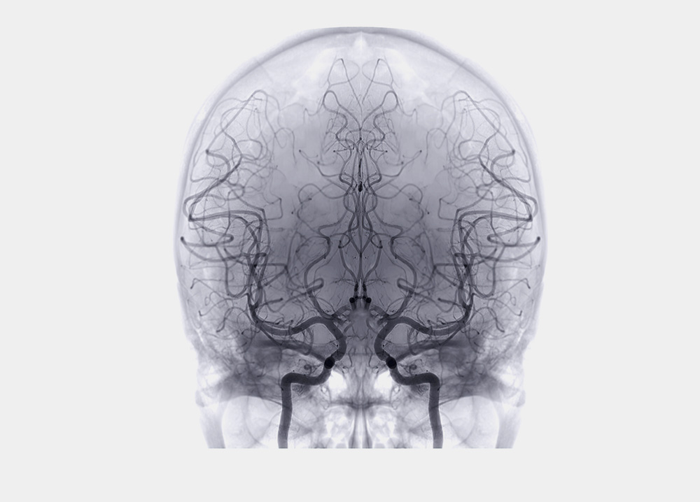Scanner vaisseaux cérébral