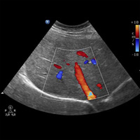 Echographie Doppler abdominopelvienne 2