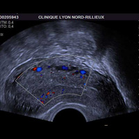 Echographie Doppler abdominopelvienne 3