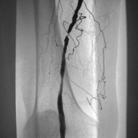 Angiographie 1