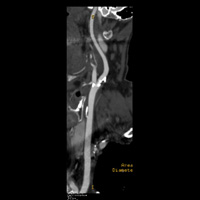 AngioScanner des vaisseaux du cou 1