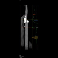 AngioScanner des vaisseaux du cou 3