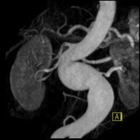 AngioScanner de l'aorte et des artères 1