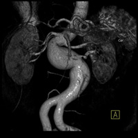AngioScanner de l'aorte et des artères 2