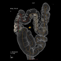 Coloscopie virtuelle ou coloscanner 1