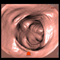 Coloscopie virtuelle ou coloscanner 3