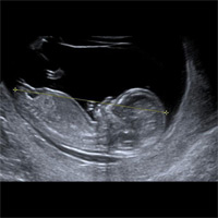 Echographie premier trimestre 1