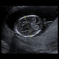 Echographie premier trimestre 3