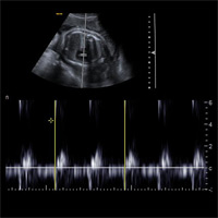 Echographie troisième trimestre 1