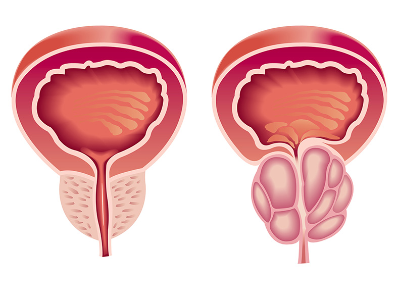 Adenome prostate