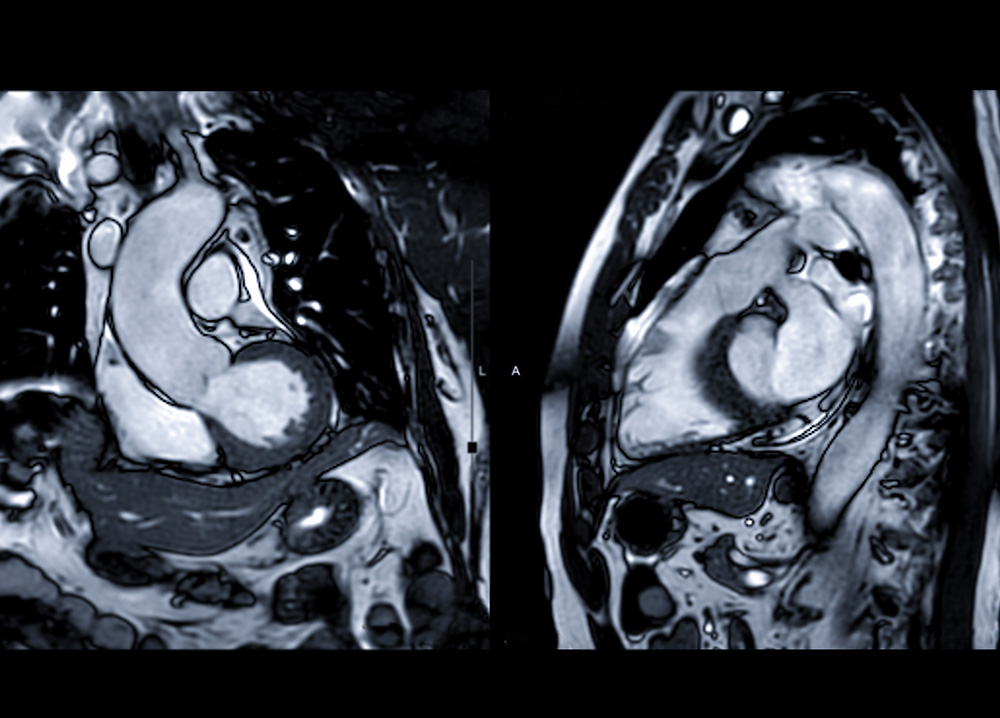 IRM cardiaque