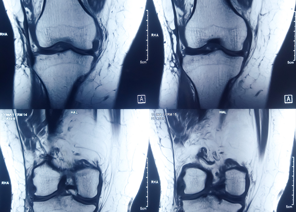 Irm Osteoarticulaire