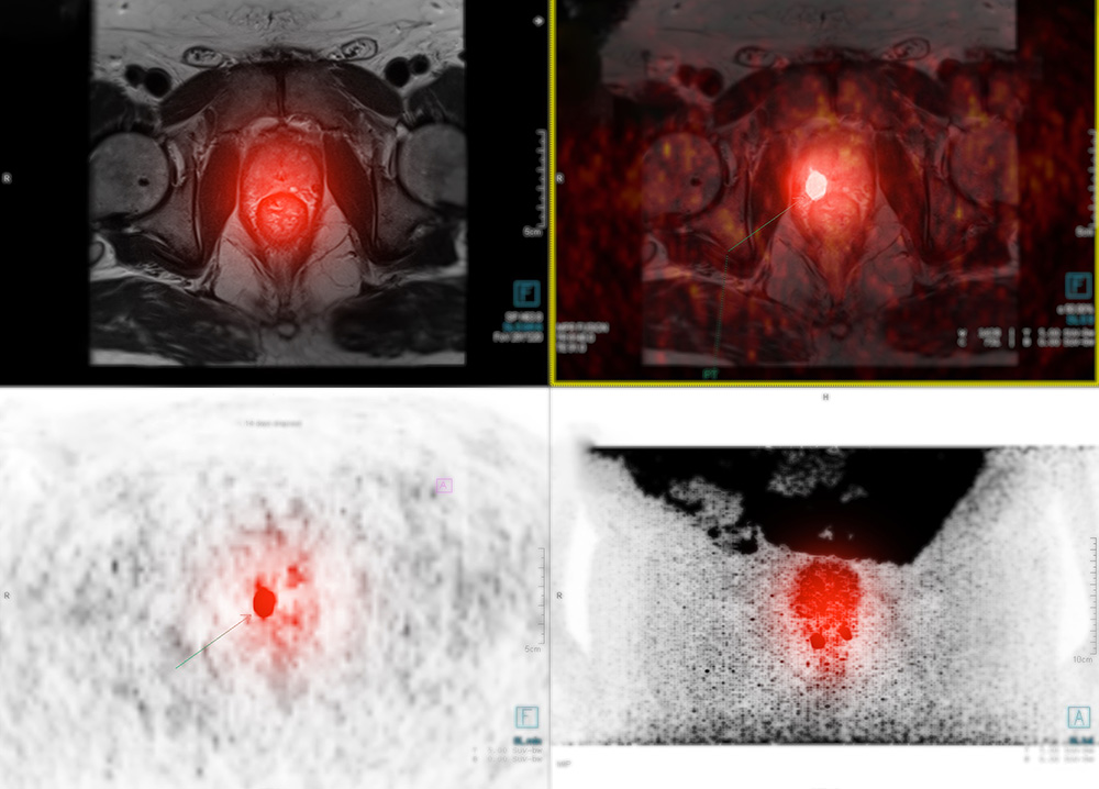 IRP prostate