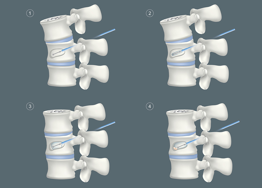 Vertebroplastie