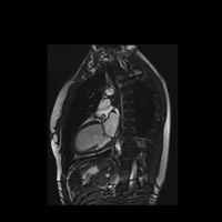 IRM cardiaque 1