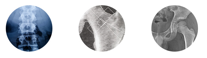 Osteodensitométrie