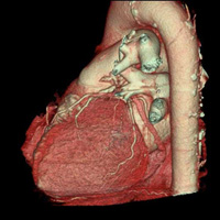 Scanner des cavités cardiaques 1