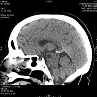 Scanner cérébral 3