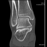 Scanner osteo-articulaire 1