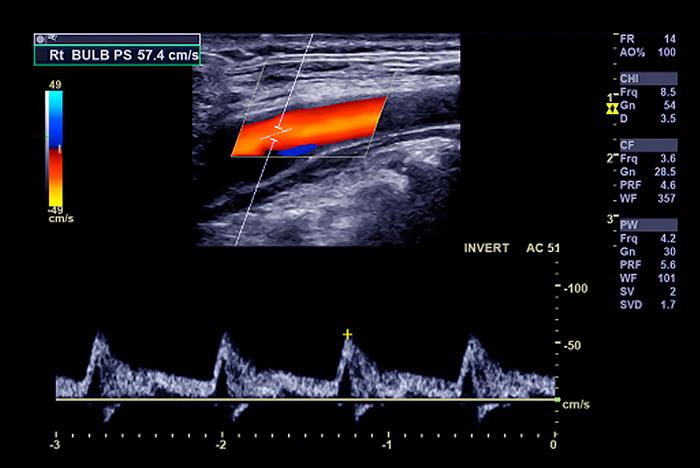 Image Echographie Doppler