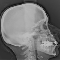 Téléradiographie du crâne face et profil 1