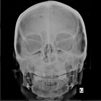 Téléradiographie du crâne face et profil 2