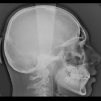 Téléradiographie du crâne face et profil 3