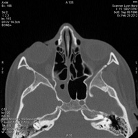 Scanner des sinus de la face 1