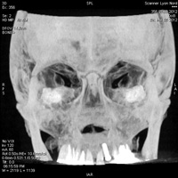 Scanner des sinus de la face 2