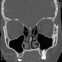 Scanner des sinus de la face 3
