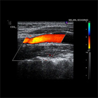 Echo Doppler des vaisseaux du cou 1