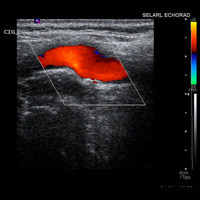 Echo Doppler des vaisseaux du cou 3